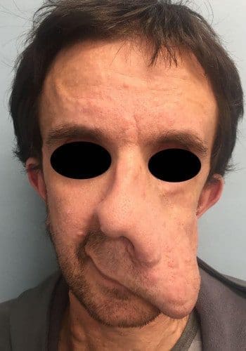 Before Image: Neurofibromatosis Case Study 2 – Surgical Insight - front