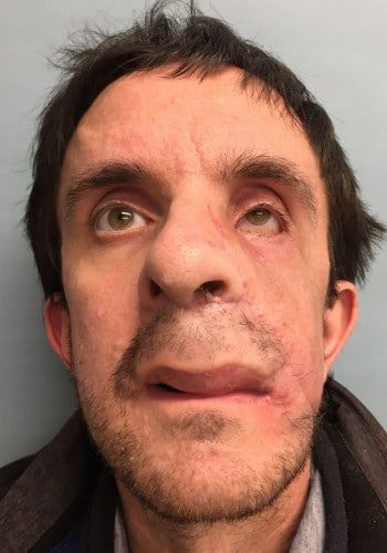 After Image: Neurofibromatosis Case Study 2 – Surgical Insight - front