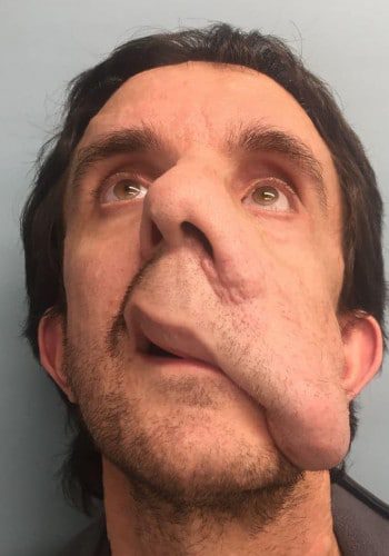 Before Image: Neurofibromatosis Case Study 2 – Surgical Insight - front