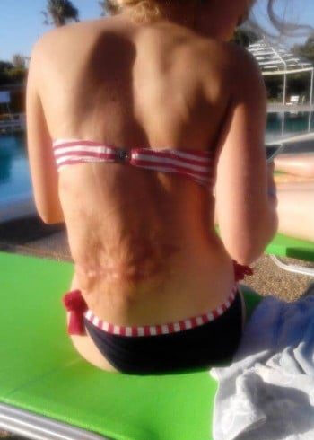 After Image: Arteriovenous Malformation - back