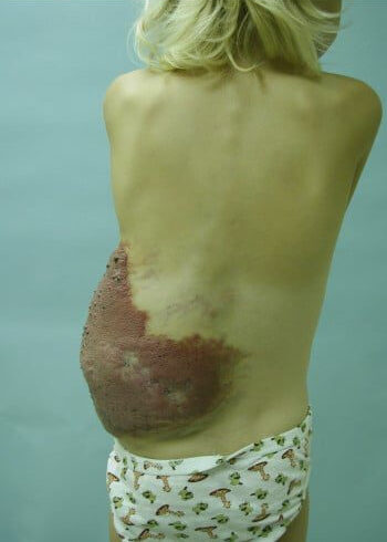 Before Image: Arteriovenous Malformation - back