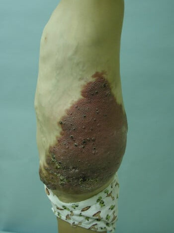 Before Image: Arteriovenous Malformation - left-side
