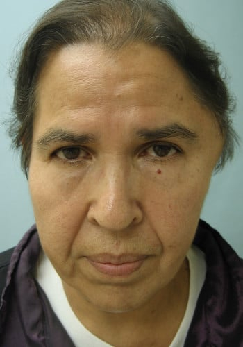 Before Image: Arterio-Venous Malformation - front