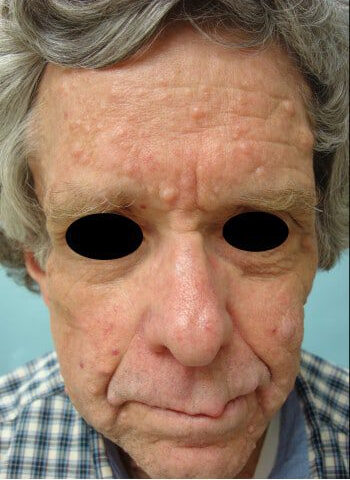 After Image: Neurofibromatosis Case Study 1 – Reconstructive Overview - front