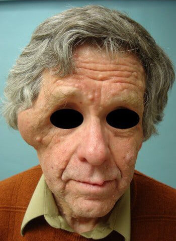 Before Image: Neurofibromatosis Case Study 1 – Reconstructive Overview - front
