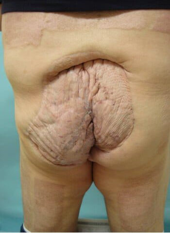 After Image: ArterioVenous Malformation - front