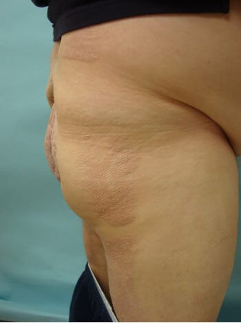 After Image: ArterioVenous Malformation - right-side