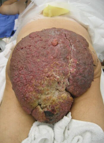 Before Image: ArterioVenous Malformation - front