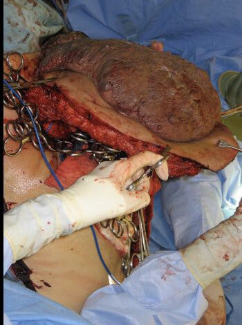Before Image: ArterioVenous Malformation - right-side