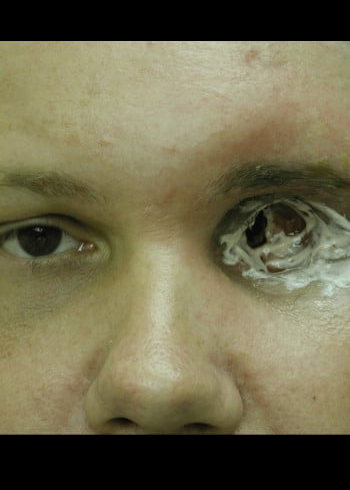 After Image: ArterioVenous Malformation - front