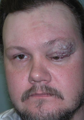 Before Image: ArterioVenous Malformation - front