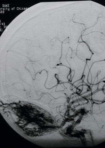 Before Image: ArterioVenous Malformation - front
