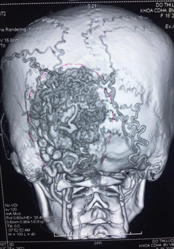 After Image: Arteriovenous Malformation - back