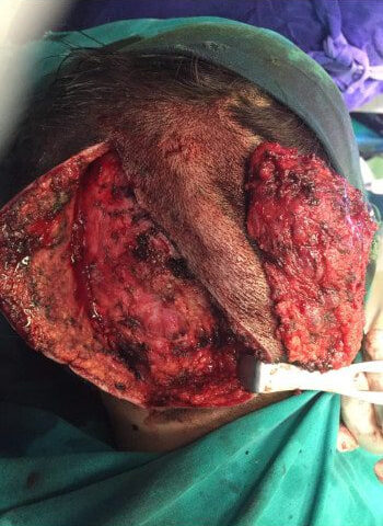 After Image: Arteriovenous Malformation - back