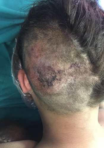 Before Image: Arteriovenous Malformation - back