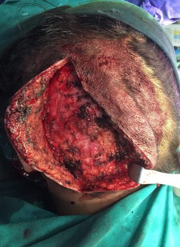 Before Image: Arteriovenous Malformation - back