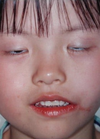 After Image: Facial Cleft Reconstruction - front