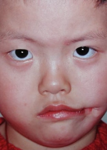 Before Image: Facial Cleft Reconstruction - front