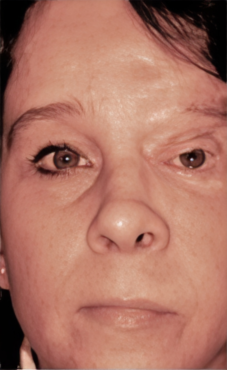 After Image: Neurofibromatosis Case Study 24 – Treatment Overview - front