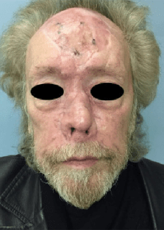 After Image: Nasal Reconstruction - front