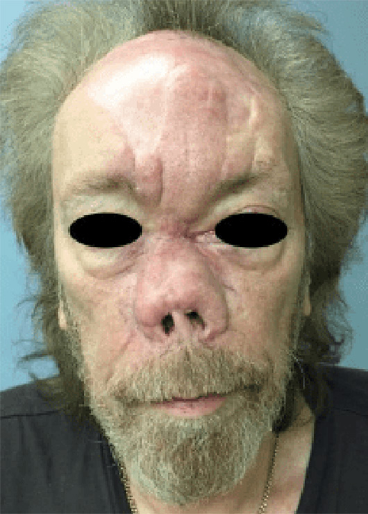 Before Image: Nasal Reconstruction - front
