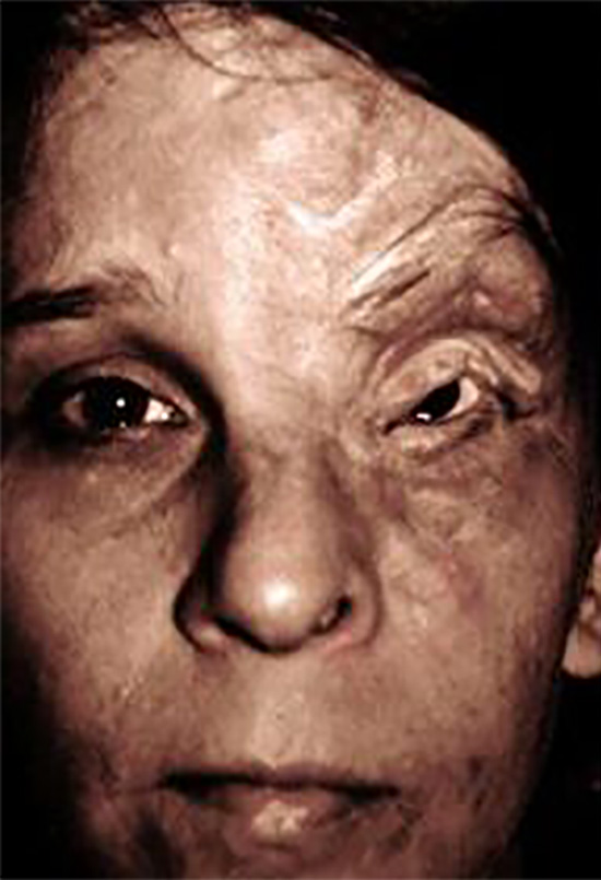 Before Image: Neurofibromatosis Case Study 24 – Treatment Overview - front