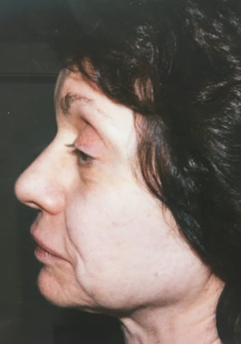 Before Image: Facelift, Blepharoplasty - left-side