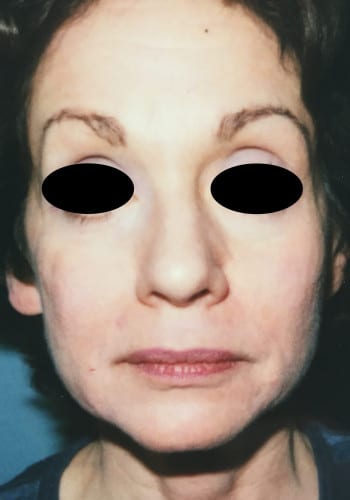 Before Image: Facelift, Blepharoplasty - front