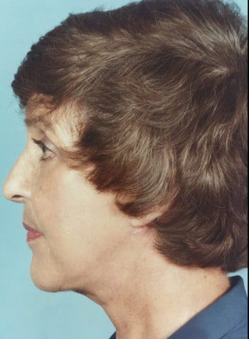 After Image: Facelift and Blepharoplasty - left-side
