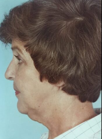 Before Image: Facelift and Blepharoplasty - left-side