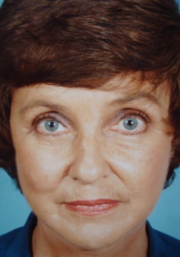 After Image: Facelift and Blepharoplasty - front