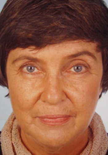 Before Image: Facelift and Blepharoplasty - front