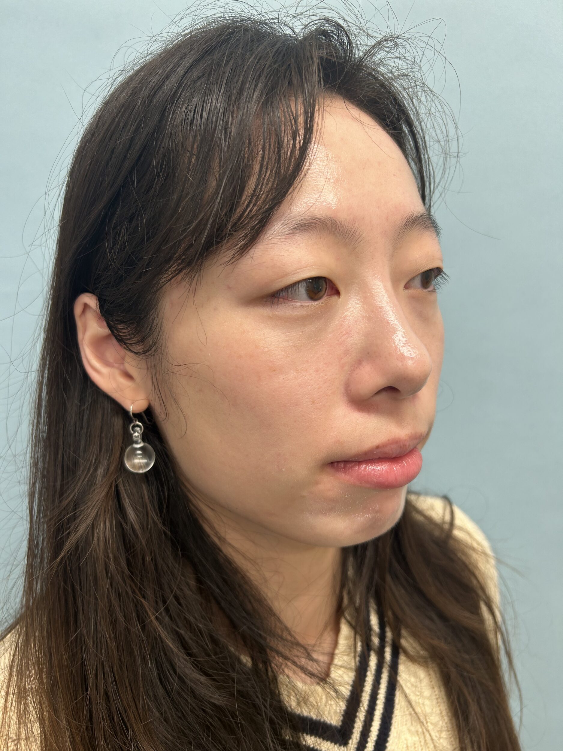 Before Image: Genioplasty - right-front-oblique