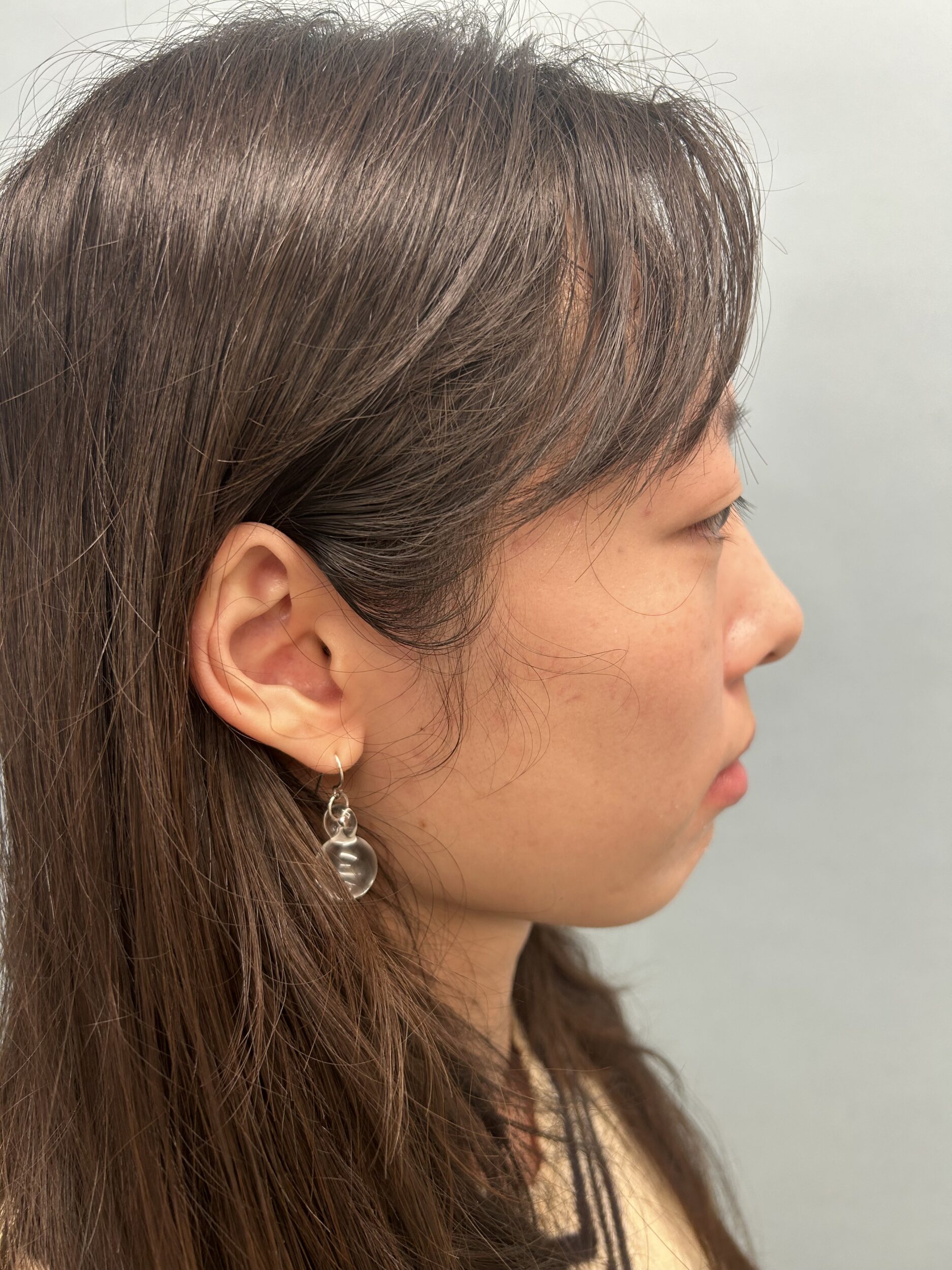 Before Image: Genioplasty - right-side