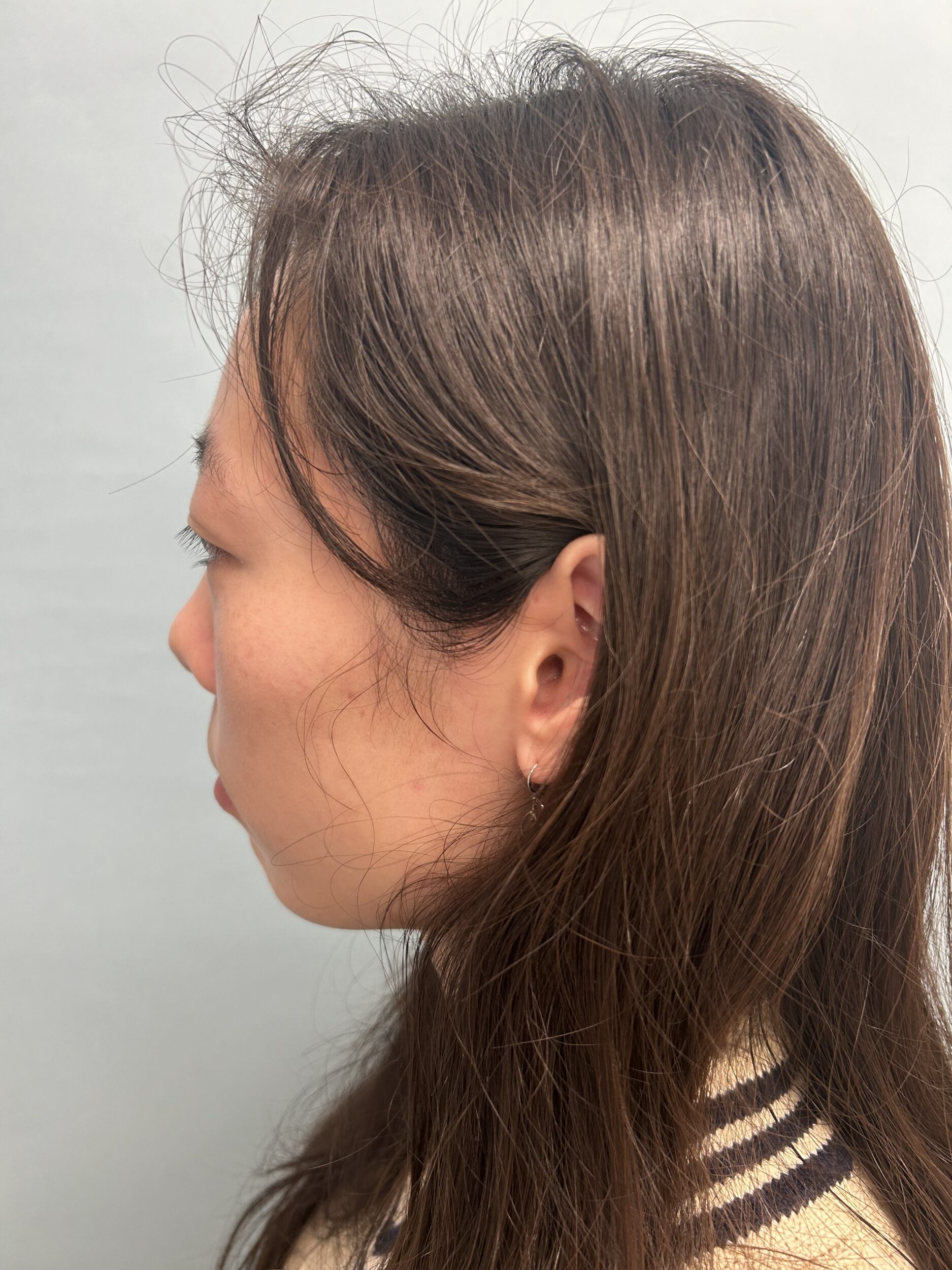 Before Image: Genioplasty - right-front-oblique