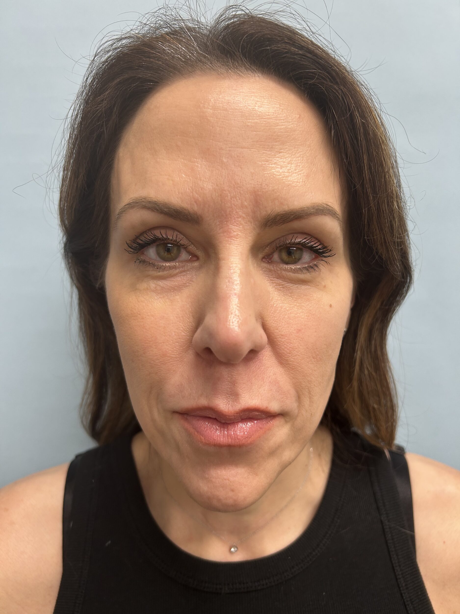 Before Image: Facelift - front