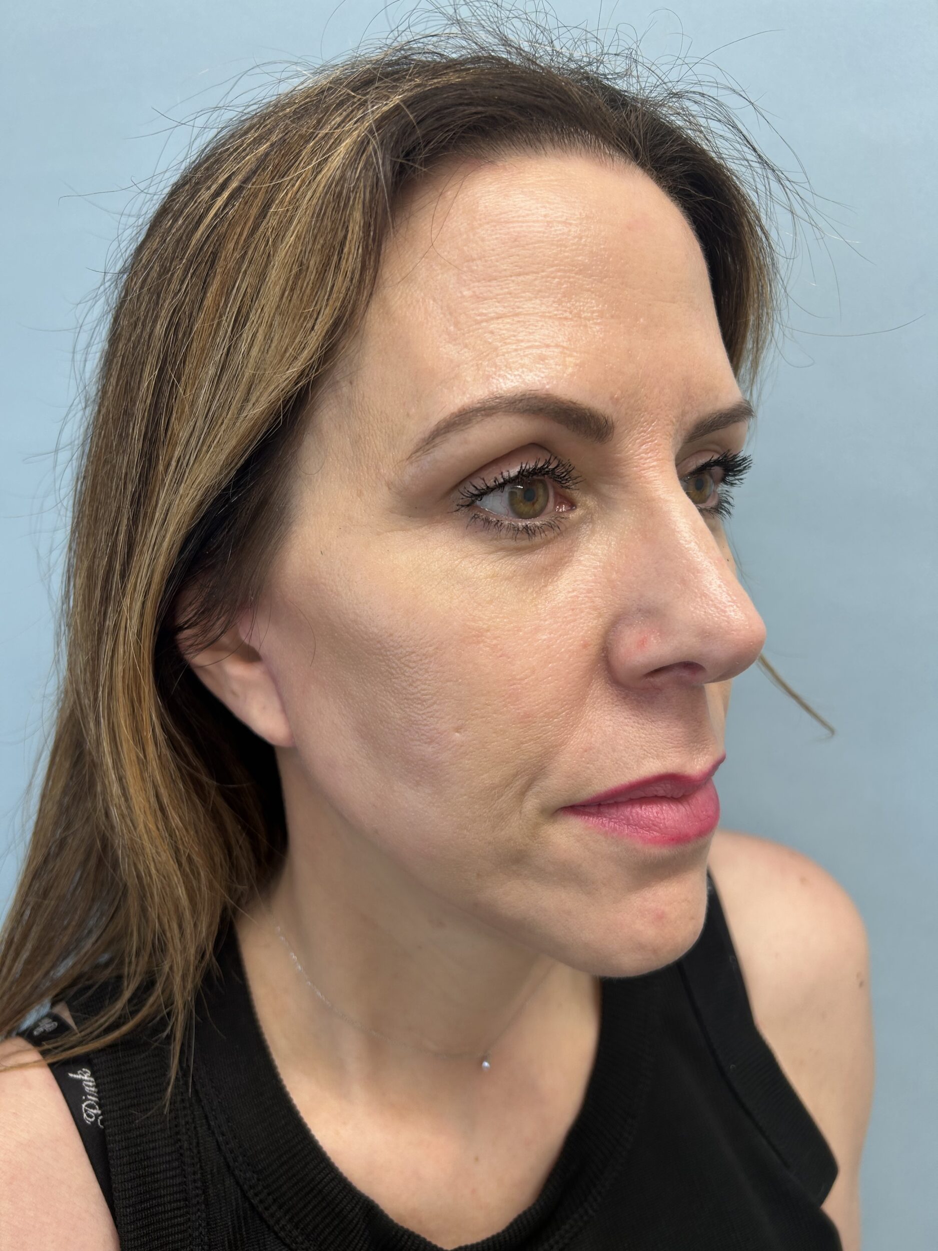 Before Image: Facelift - right-front-oblique