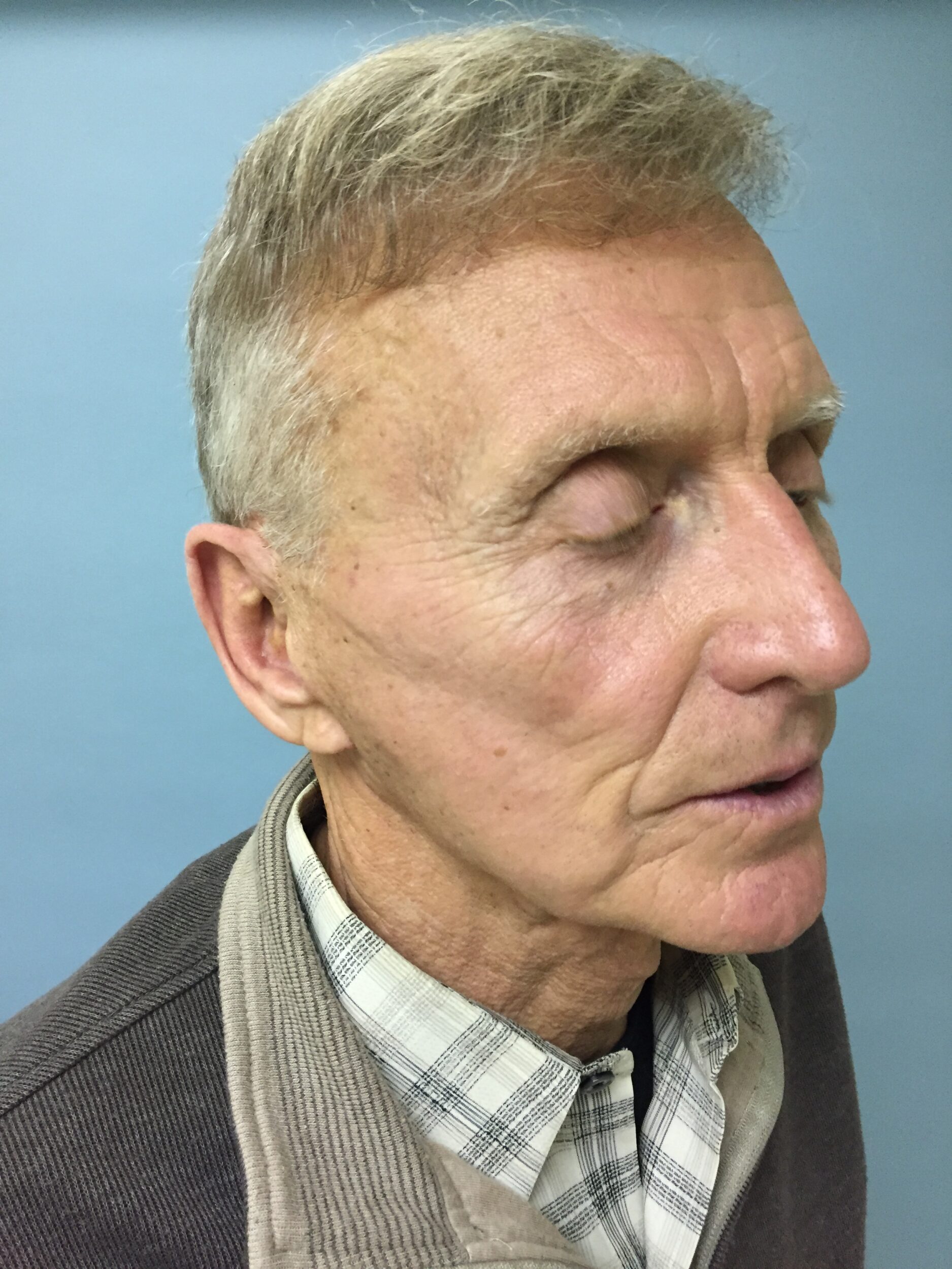 Before Image: Facelift - right-front-oblique