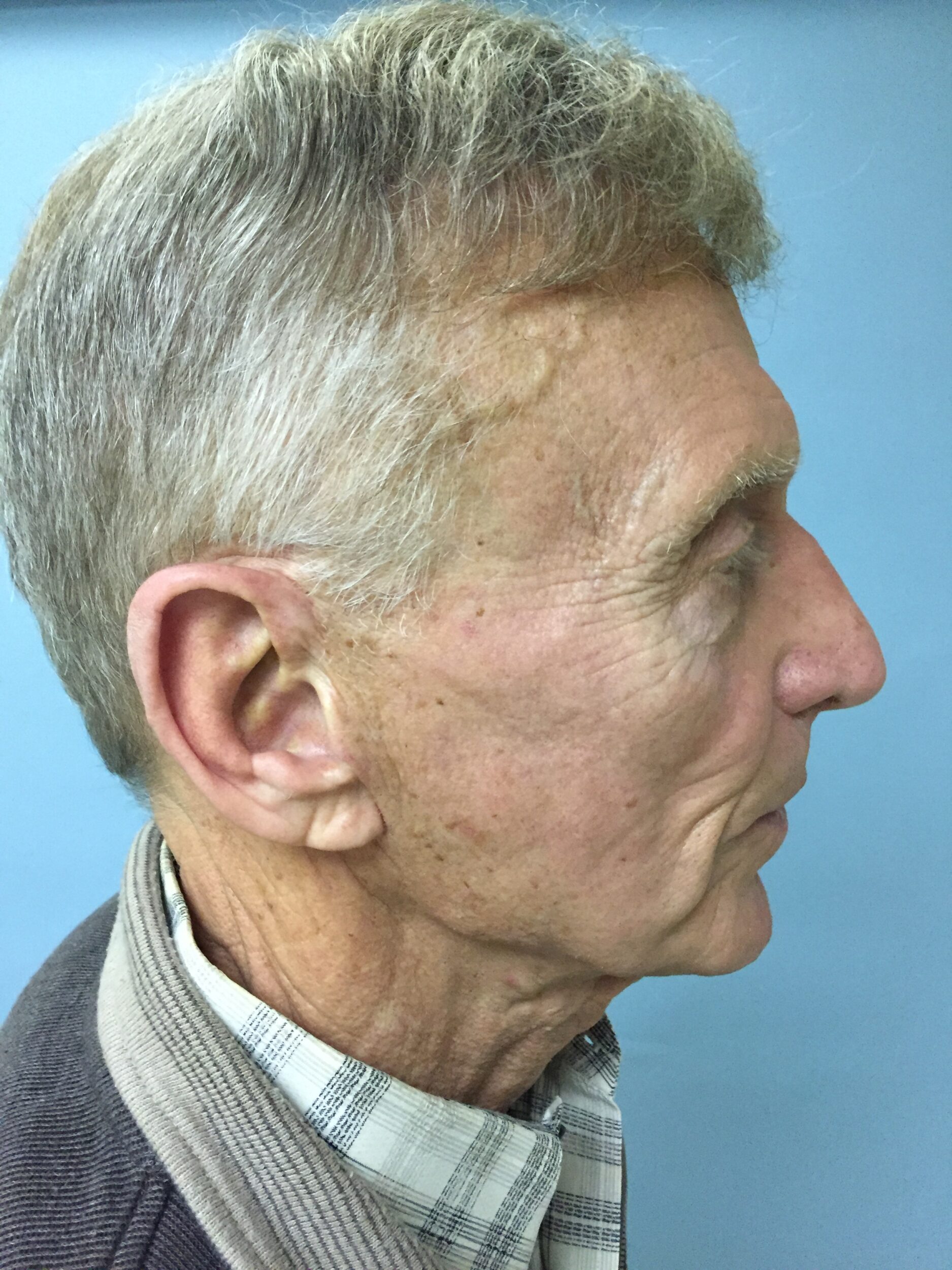 Before Image: Facelift - right-side