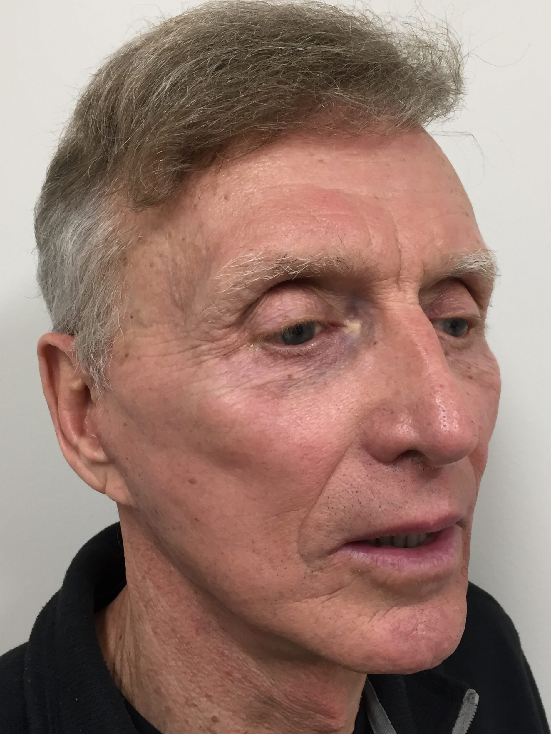 After Image: Facelift - right-front-oblique