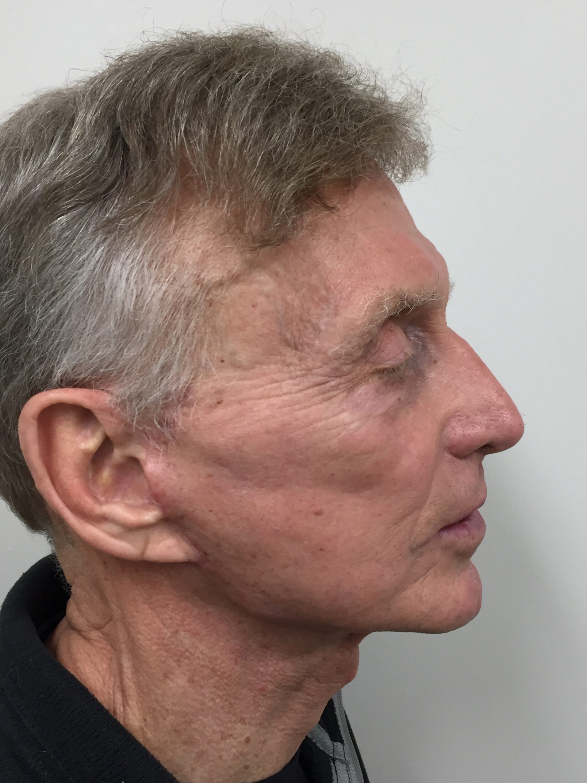 After Image: Facelift - right-side