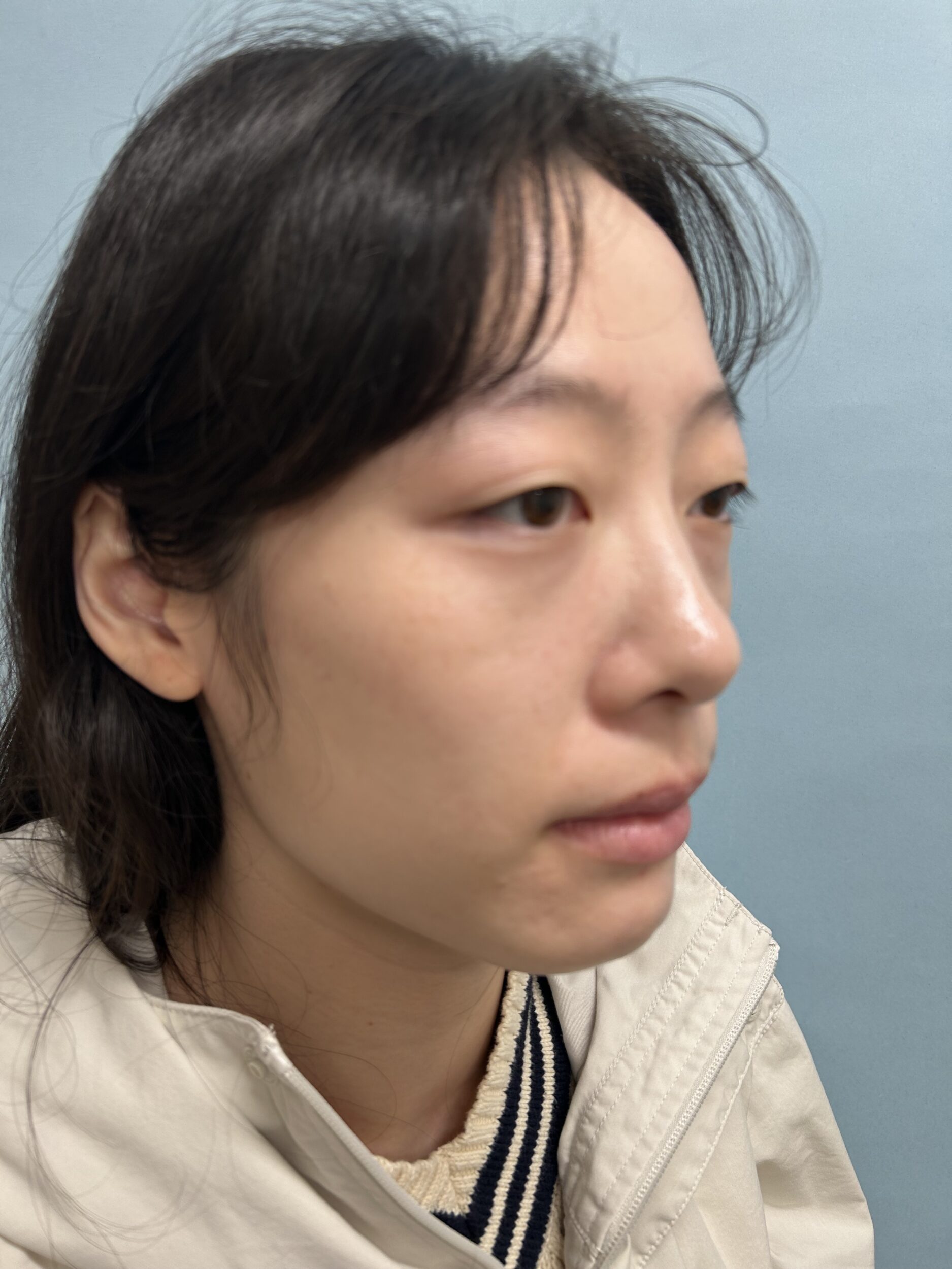 After Image: Genioplasty - right-front-oblique