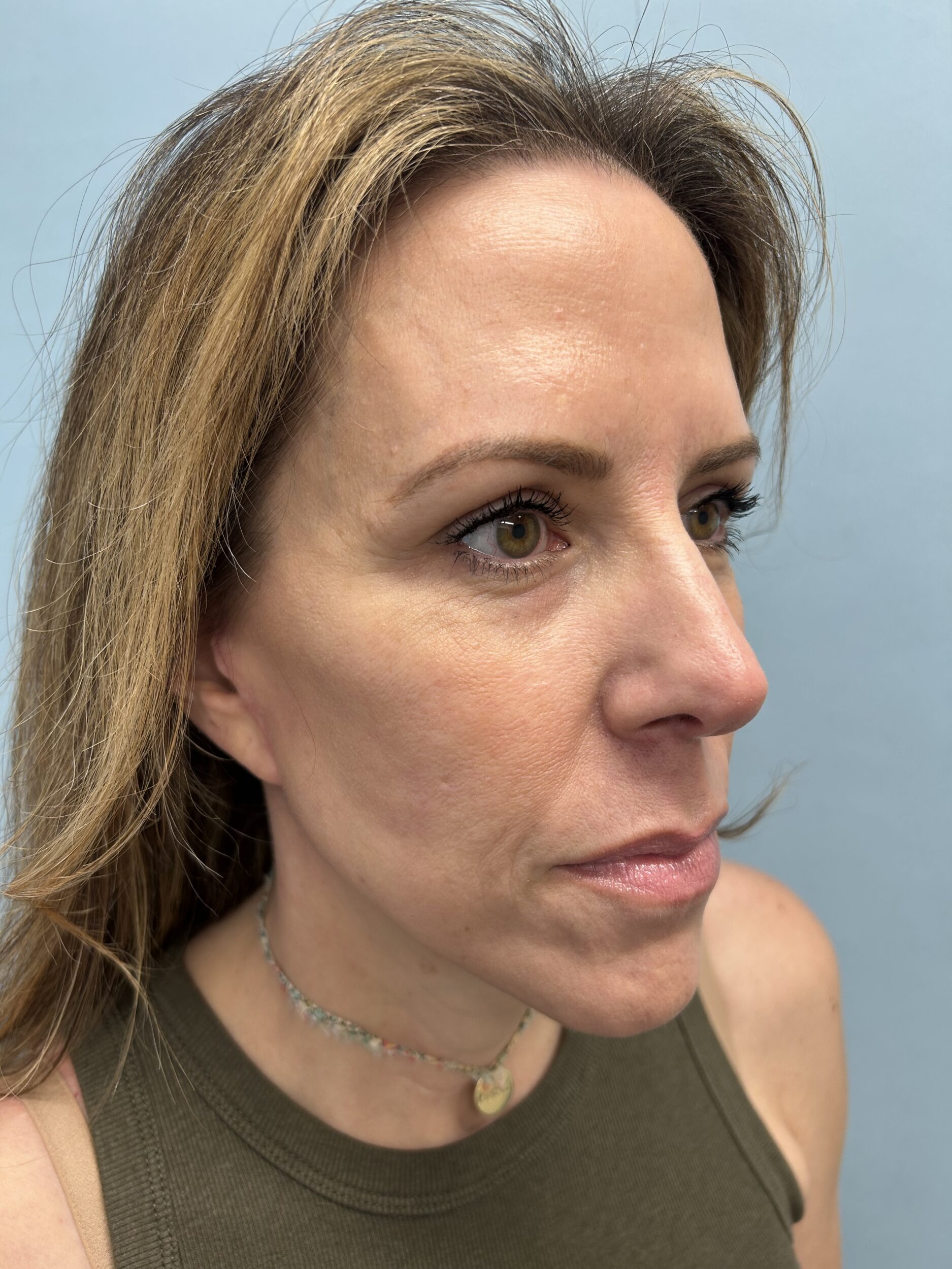After Image: Facelift - right-front-oblique