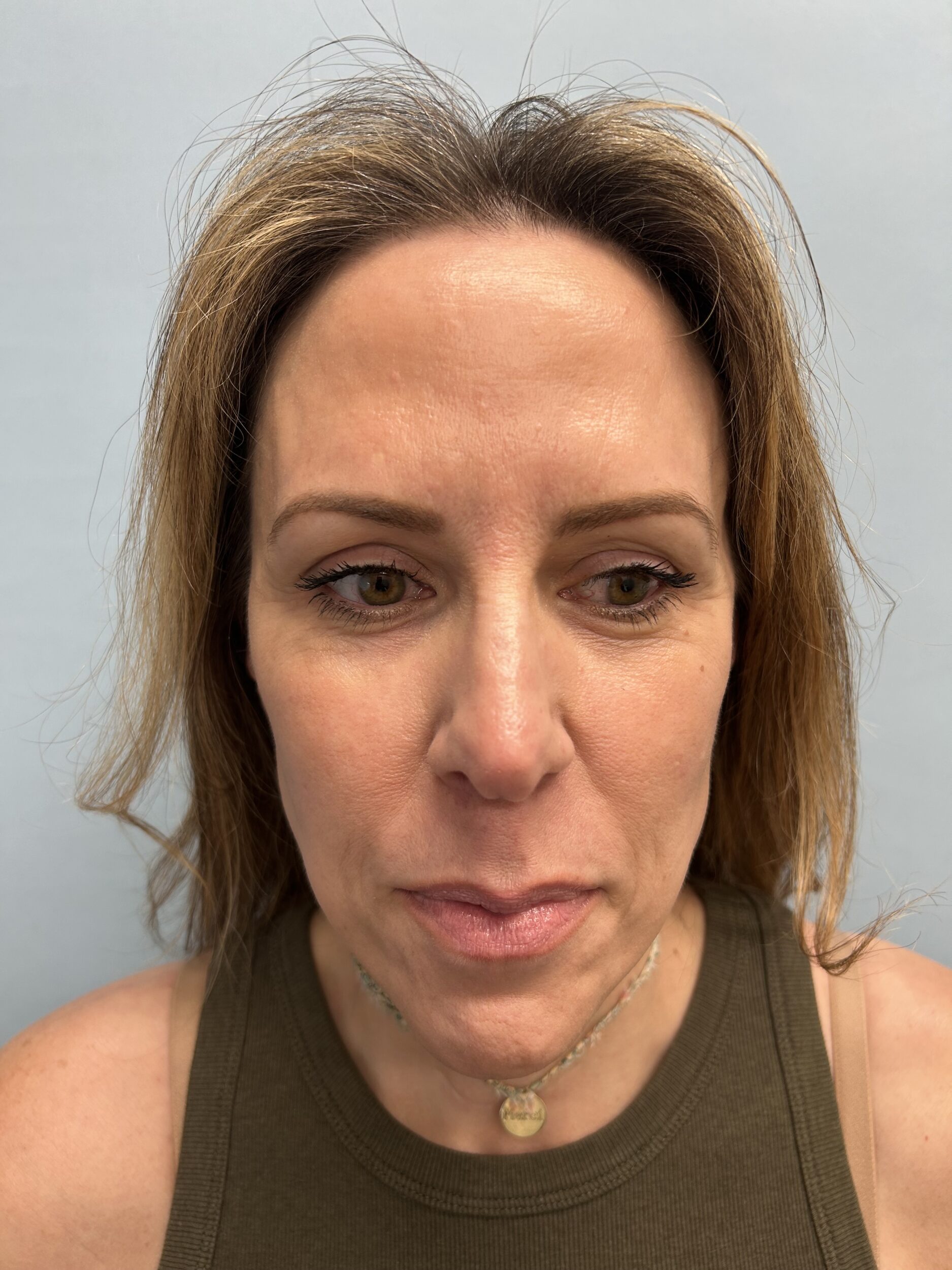 After Image: Facelift - front