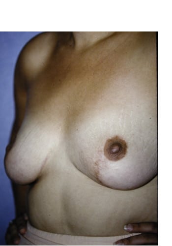 Asymmetric Breasts