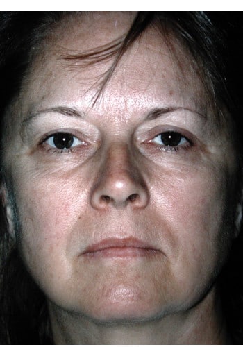 Facelift, Blepharoplasty, Browlift