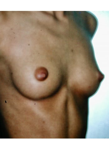 Breast Augmentation