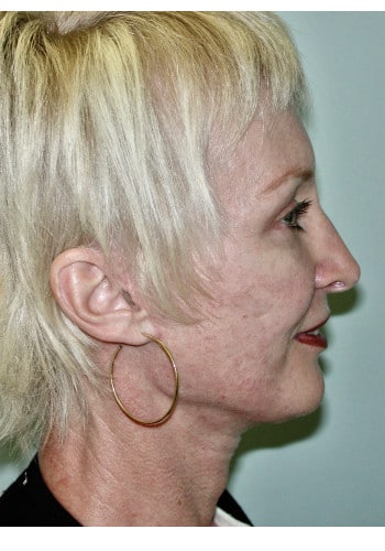 Facelift, Blepharoplasty, Rhinoplasty