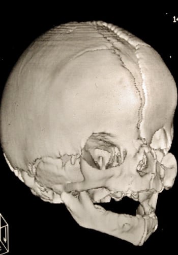 Craniosynostosis