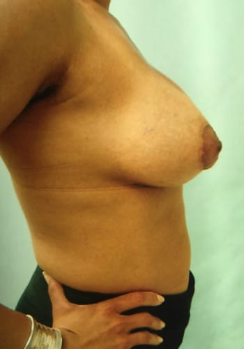 Mastopexy, Breast Augmentation